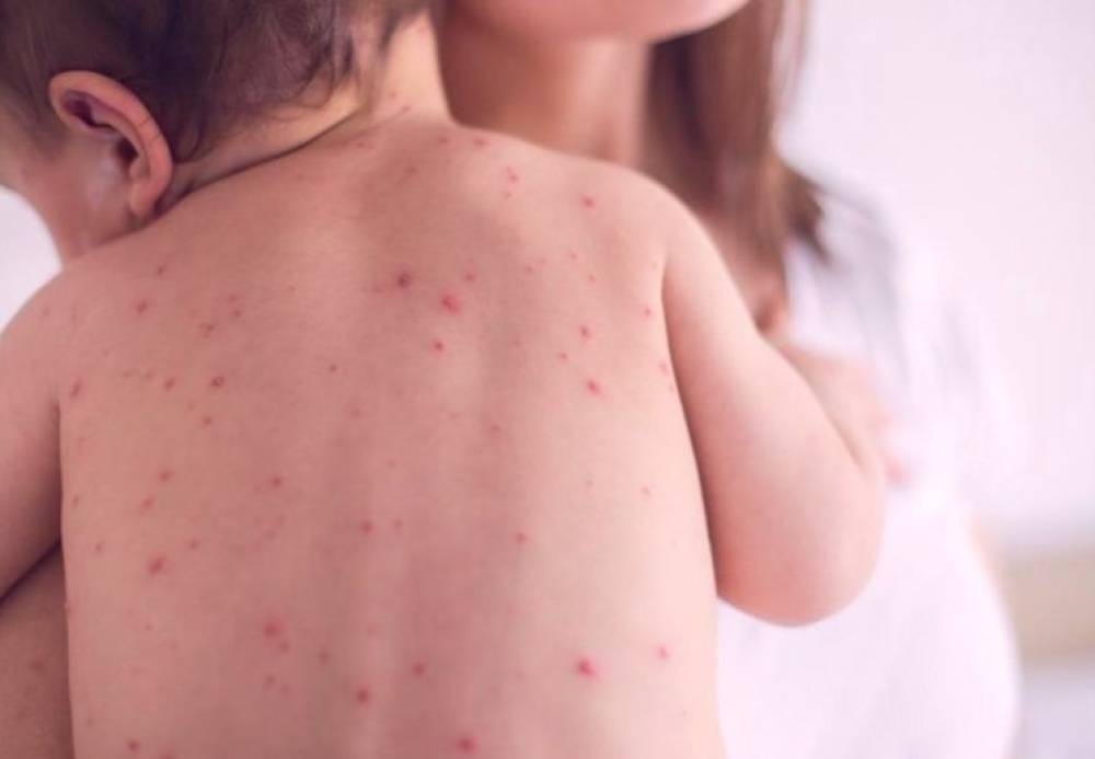 Улаанбурхан өвчний гурав дахь тохиолдол батлагдлаа
